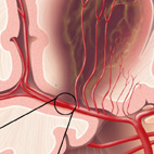 ischemic stroke hemorrhage